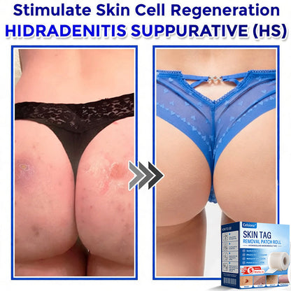 🍀💯Celsiora® Multi-Functional Microneedle Hydrocolloid Patch Roll | Targets Skin Tags, Warts & Stubborn Blemishes