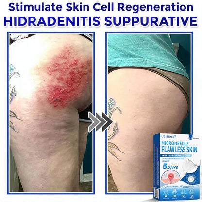 🍀🌿Celsiora® 2-in-1 Microneedle & Hydrocolloid Patch | Raised Moles,Acne, Flat Warts & Skin Tags Remover | Improves Wrinkles, Scars & Blemishes | Invisible Pimple Patches for Face & Body | 24 Count