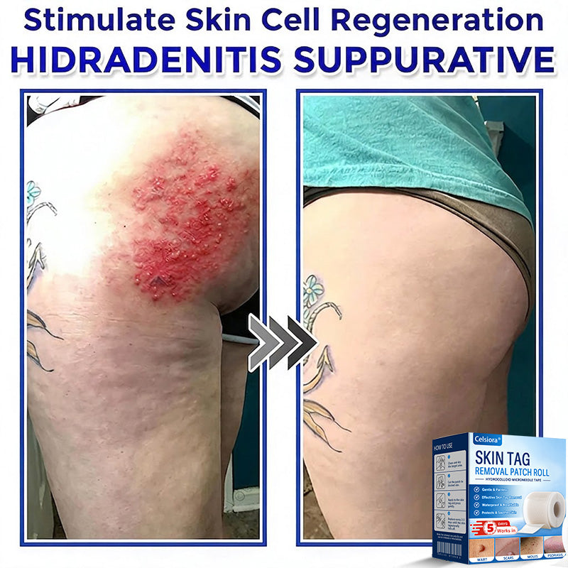 🍀💯Celsiora® Multi-Functional Microneedle Hydrocolloid Patch Roll | Targets Skin Tags, Warts & Stubborn Blemishes