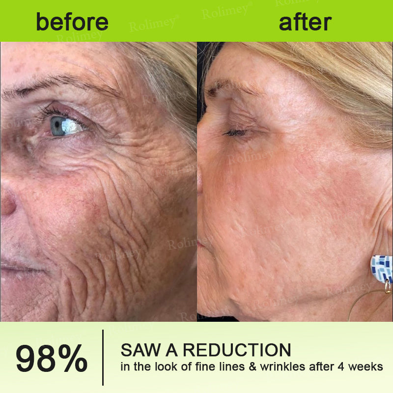 🍀Made and shipped from Canada 💫Rolimey® Botox & Vita-A Retinol Shot Wrinkle-Lift Tightening cream - Last Day Promotion 50% OFF