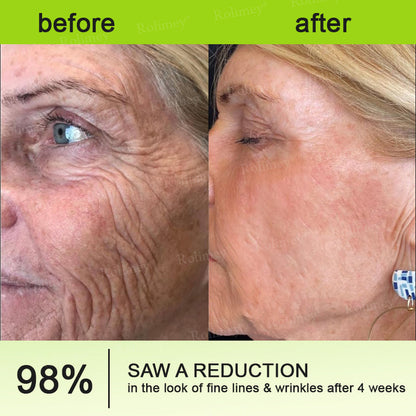 🍀Made and shipped from Canada 💫Rolimey® Botox & Vita-A Retinol Shot Wrinkle-Lift Tightening cream - Last Day Promotion 50% OFF