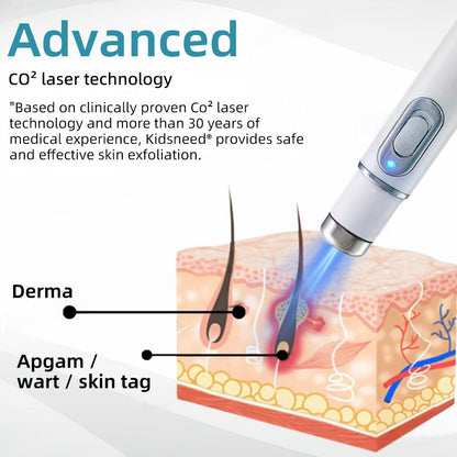 Remifa® Non-invasive Mole & Wart Removal Laser Pen(Quick and painless removal of warts, moles, age spots, and skin tags with no side effects)