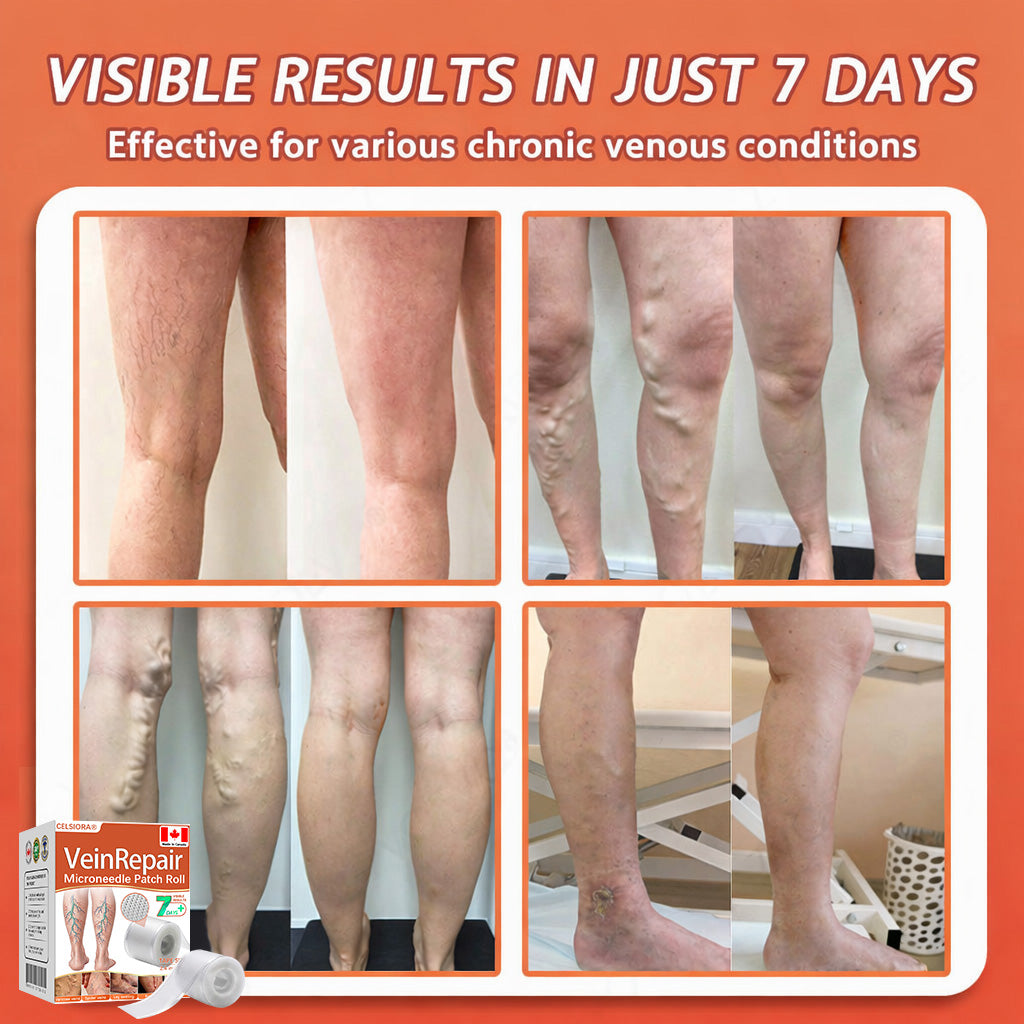 ☘️☘️Celsiora® Vein Ease Microneedle Care Patch(For Spider Veins, Varicose Veins, Swelling & Leg Fatigue) - Last Day Promotion 50% OFF