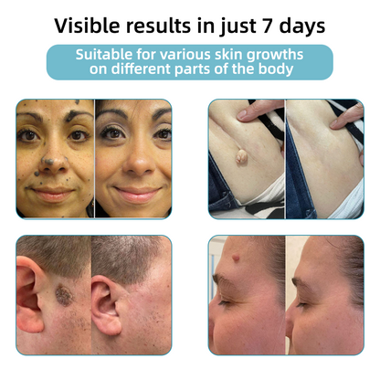 Remifa® Non-invasive Mole & Wart Removal Laser Pen(Quick and painless removal of warts, moles, age spots, and skin tags with no side effects)