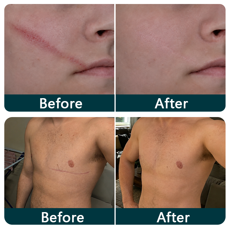 🍁TRILUMIA® SILICONE SCAR THERAPY ROLL  Help Soften, Flatten & Improve the Appearance of Raised Scars