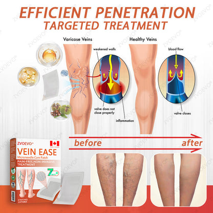 ☘️🎉Zvoevo® Vein Ease Microneedle Care Patch(For Spider Veins, Varicose Veins, Swelling & Leg Fatigue) - Last Day Promotion 50% OFF