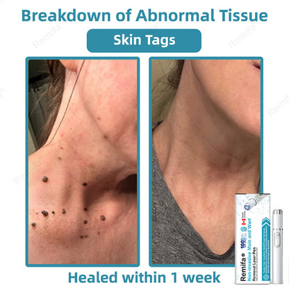 👩‍⚕️🌟Remifa® Non-invasive Mole & Wart Removal Laser Pen(Quick and painless removal of warts, moles, age spots, and skin tags with no side effects)🔥