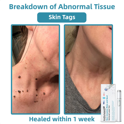 Remifa® Non-invasive Mole & Wart Removal Laser Pen(Quick and painless removal of warts, moles, age spots, and skin tags with no side effects)