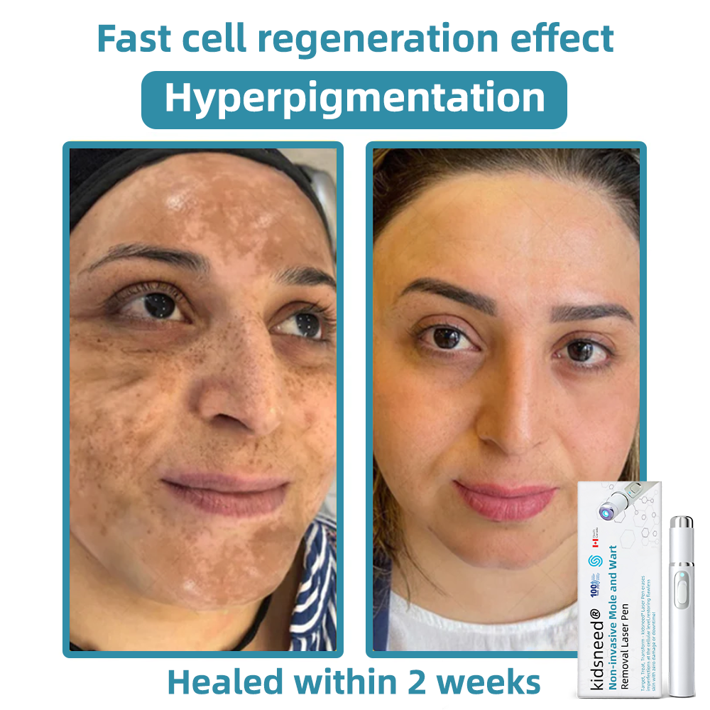 Remifa® Non-invasive Mole & Wart Removal Laser Pen(Quick and painless removal of warts, moles, age spots, and skin tags with no side effects)