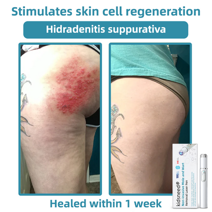 Remifa® Non-invasive Mole & Wart Removal Laser Pen(Quick and painless removal of warts, moles, age spots, and skin tags with no side effects)