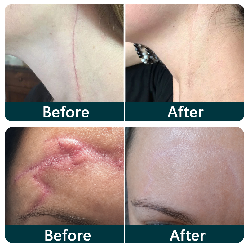 🍁TRILUMIA® SILICONE SCAR THERAPY ROLL  Help Soften, Flatten & Improve the Appearance of Raised Scars