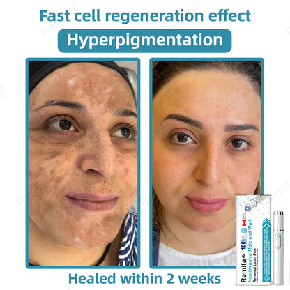 👩‍⚕️🌟Remifa® Non-invasive Mole & Wart Removal Laser Pen(Quick and painless removal of warts, moles, age spots, and skin tags with no side effects)🔥