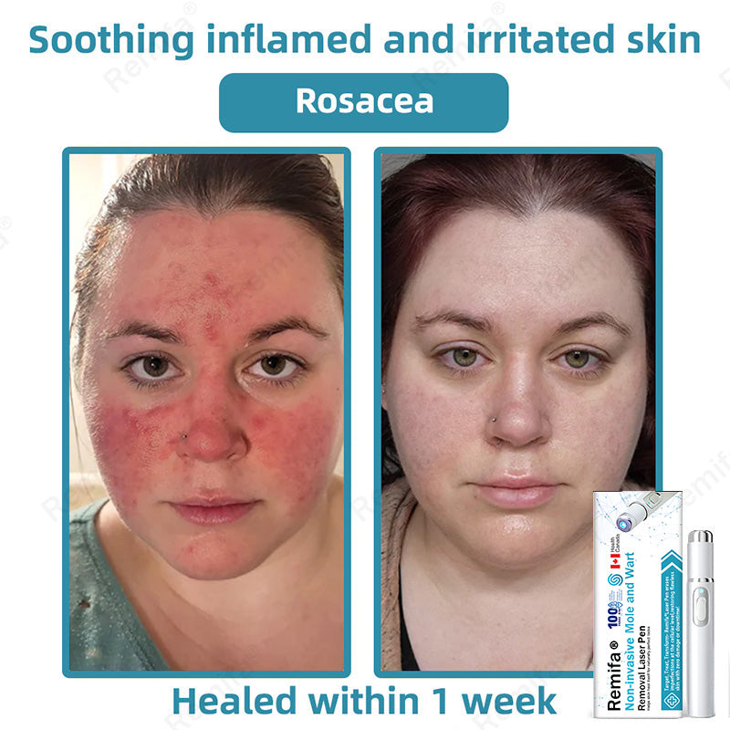 👩‍⚕️🌟Remifa® Non-invasive Mole & Wart Removal Laser Pen(Quick and painless removal of warts, moles, age spots, and skin tags with no side effects)🔥