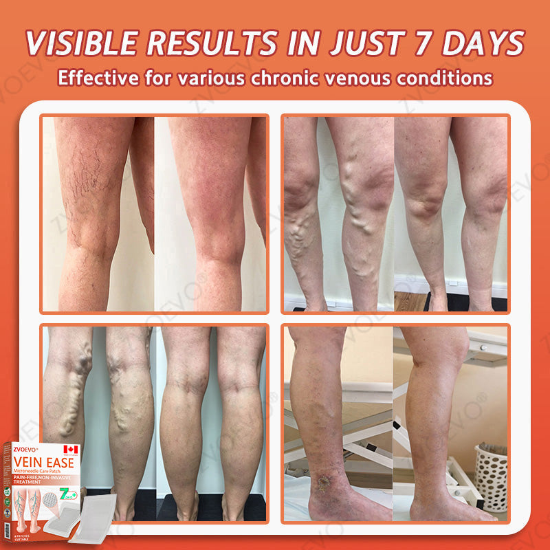 ☘️🎉Zvoevo® Vein Ease Microneedle Care Patch(For Spider Veins, Varicose Veins, Swelling & Leg Fatigue) - Last Day Promotion 50% OFF