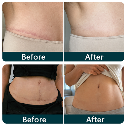 🍁TRILUMIA® SILICONE SCAR THERAPY ROLL  Help Soften, Flatten & Improve the Appearance of Raised Scars