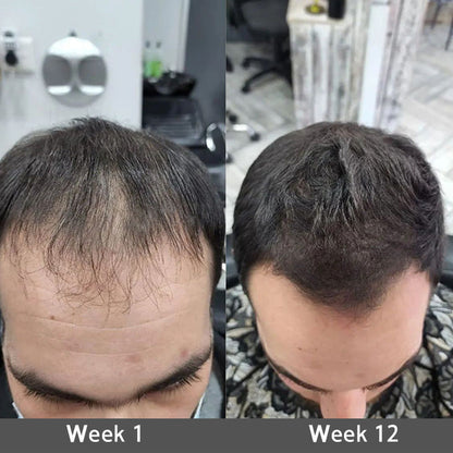 ☘️💟 Official CA Store 🇨🇦 | 🔥Rolimey® Highly Effective Biotin & Rosemary Hair Growth Serum — (🔥 Limited-Time Offer, ⏳ Last Day Promotion 50% OFF)