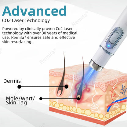 👩‍⚕️🌟Remifa® Non-invasive Mole & Wart Removal Laser Pen(Quick and painless removal of warts, moles, age spots, and skin tags with no side effects)🔥