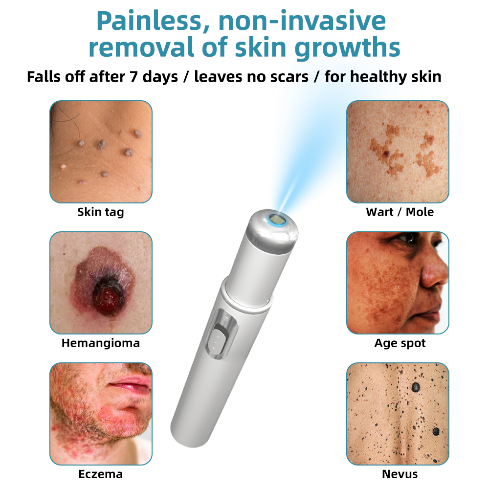 Remifa® Non-invasive Mole & Wart Removal Laser Pen(Quick and painless removal of warts, moles, age spots, and skin tags with no side effects)