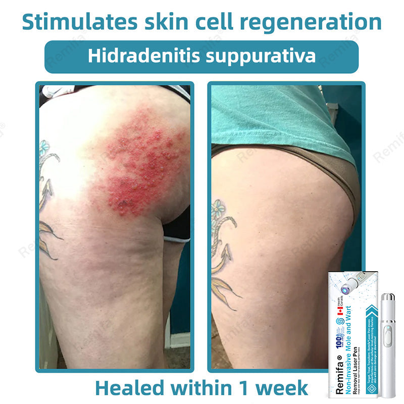 👩‍⚕️🌟Remifa® Non-invasive Mole & Wart Removal Laser Pen(Quick and painless removal of warts, moles, age spots, and skin tags with no side effects)🔥