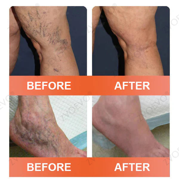 ☘️☘️Celsiora® Vein Ease Microneedle Care Patch(For Spider Veins, Varicose Veins, Swelling & Leg Fatigue) - Last Day Promotion 50% OFF