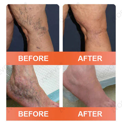 ☘️☘️Celsiora® Vein Ease Microneedle Care Patch(For Spider Veins, Varicose Veins, Swelling & Leg Fatigue) - Last Day Promotion 50% OFF