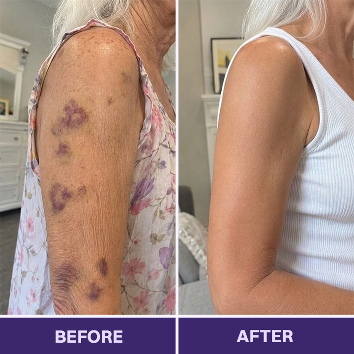 ✨✨Evolvion® Bruise Repair & Skin-Strengthening Cream-Advanced daily care for bruise-prone skin