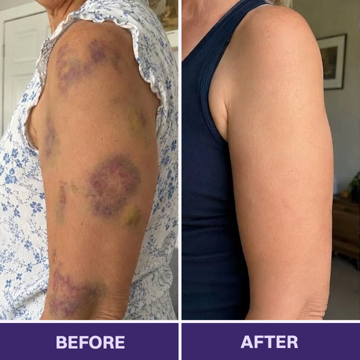 ✨✨Evolvion® Bruise Repair & Skin-Strengthening Cream-Advanced daily care for bruise-prone skin