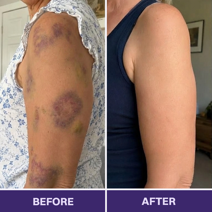 ✨✨Evolvion® Bruise Repair & Skin-Strengthening Cream-Advanced daily care for bruise-prone skin