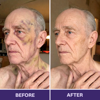 ✨✨Evolvion® Bruise Repair & Skin-Strengthening Cream-Advanced daily care for bruise-prone skin