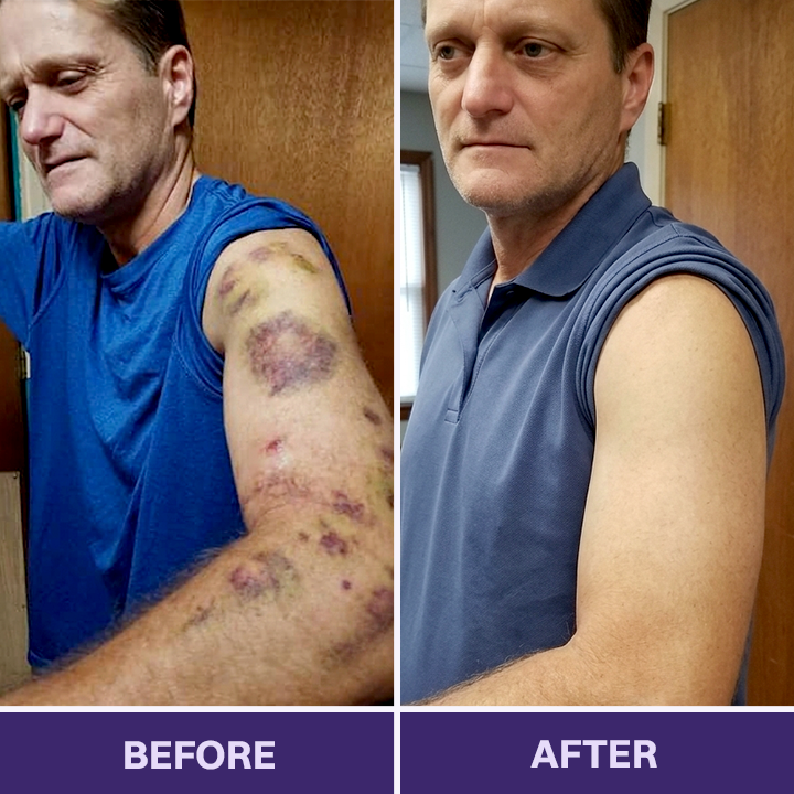 ✨✨Evolvion® Bruise Repair & Skin-Strengthening Cream-Advanced daily care for bruise-prone skin