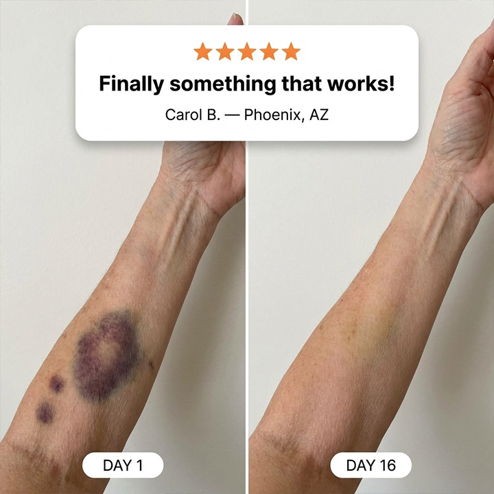 ✨✨Evolvion® Bruise Repair & Skin-Strengthening Cream-Advanced daily care for bruise-prone skin