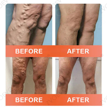 ☘️🎉Zvoevo® Vein Ease Microneedle Care Patch(For Spider Veins, Varicose Veins, Swelling & Leg Fatigue) - Last Day Promotion 50% OFF